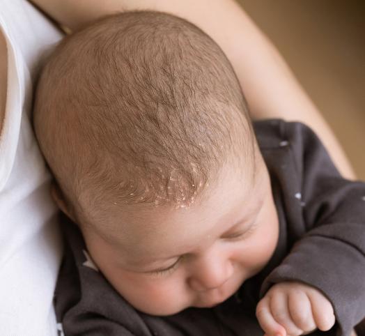 Молочные корочки на голове у новорожденного: как убрать себорейные корочки  у грудничка | MUSTELA